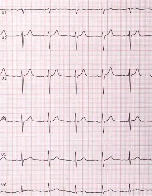 体检心电图提示"窦性心律",是什么病?心血管医生告诉你