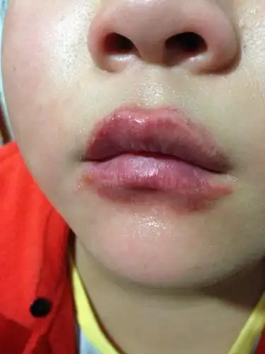 我妹妹的嘴巴这里是什么病擦唇膏都擦不好