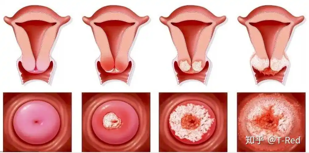 宫颈癌是怎样发展而来的?