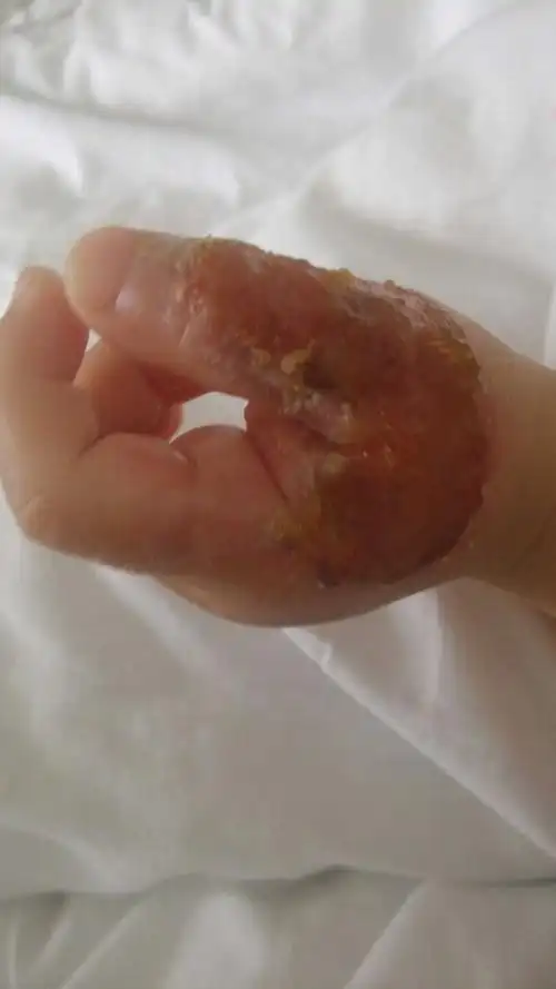 宝宝的烫伤,我想记录下来提醒自己