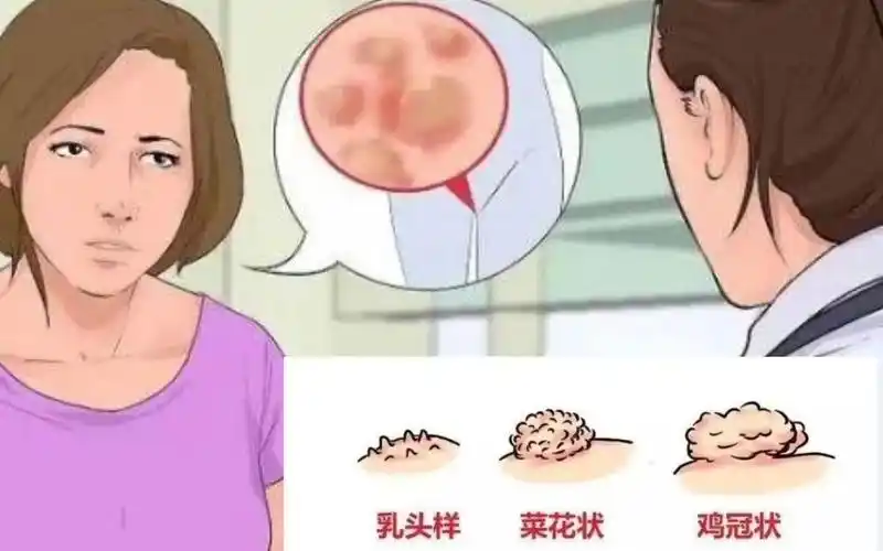 下面长菜花状赘生物 不痛不痒有异味小心是尖锐湿疣