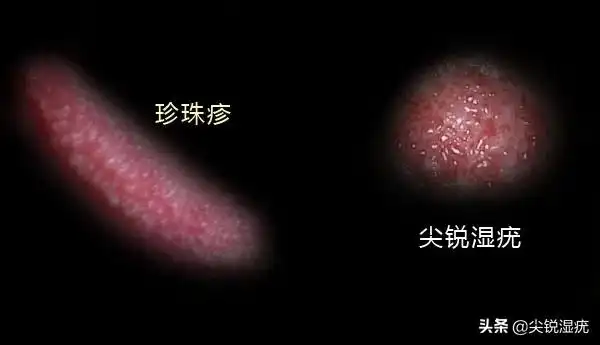 珍珠疹图片珍珠疹图片症状图片