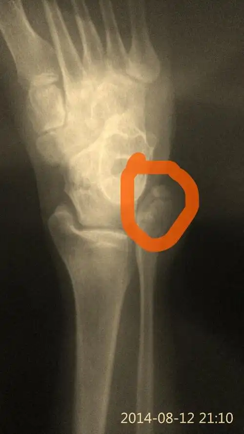 腓骨头部骨折30天后看x片,最快多久可以脱拐?