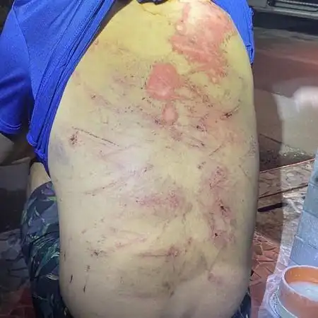 高雄男疑遭淋油虐烧全身恐怖疤痕晕倒街头却辩跌倒受伤