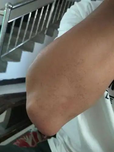 手臂上出现的这种斑点是怎么回事?