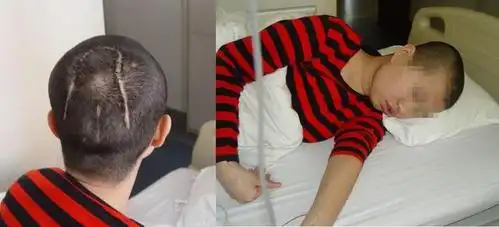 2011-12-14 入院当天嗜睡,双眼呈"落日征",双眼球上提不能2011年12月