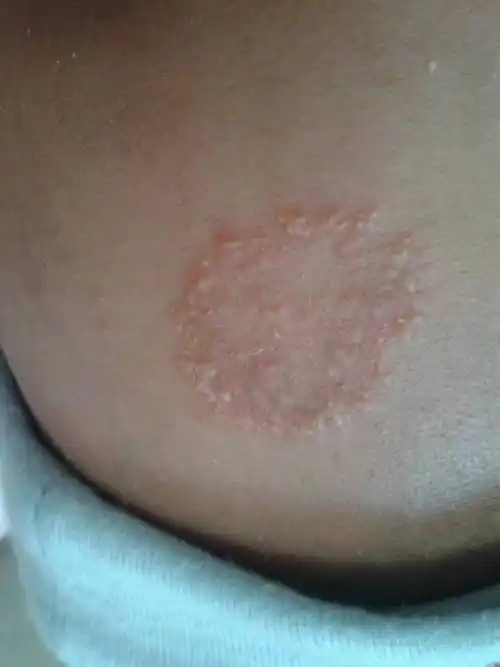 我家宝宝刚出生二十二天,宝宝头上长了一圈痘痘而且