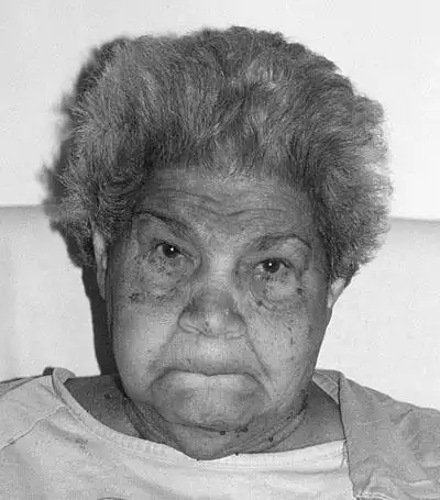 甲减中的粘液性水肿