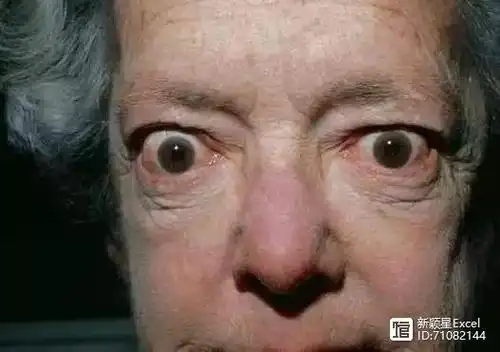 而且有研究认为,有些情况眼球过分凸出,很可能是身体检查出了问题的呢