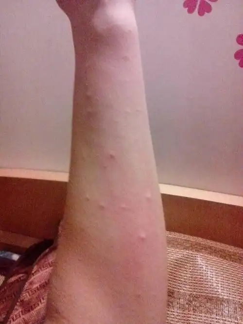 2014-02-25 王晓奇 主治医师 女儿抱狗之后身上出了很多的小红疙瘩 吃