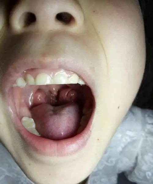 喉咙发炎怎么办,嗓子发炎能吃鱼吗图2