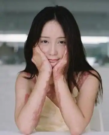 烧伤女孩勇敢晒写真 浴火重生连伤疤都是那么美(组图)