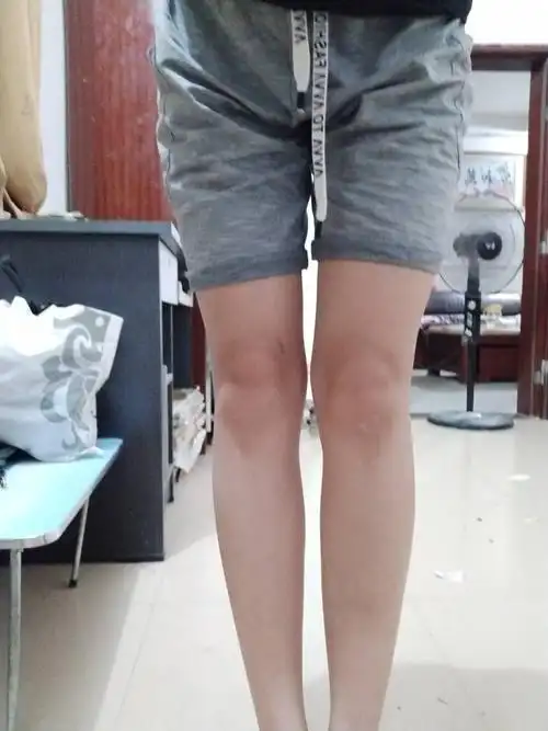 这种是x型腿吗,严不严重,还有的救吗