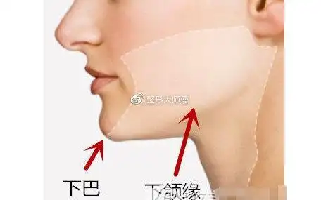 下颌缘抽脂和双下巴吸脂的区别是什么可以一起做吗