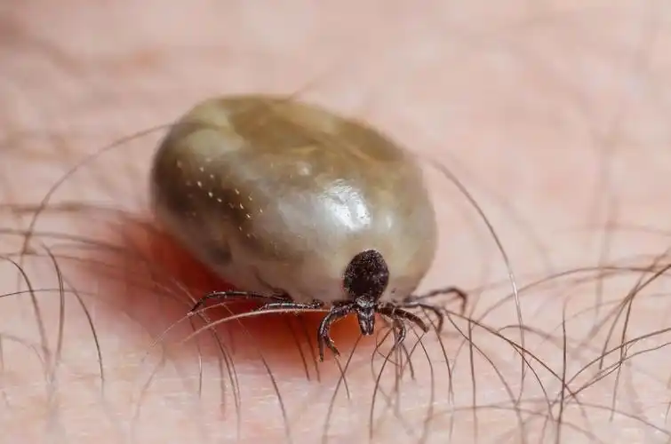 满腔热血坐在人体皮肤上的蜱虫.