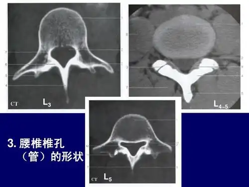 腰椎椎孔 (管)的形状 l5