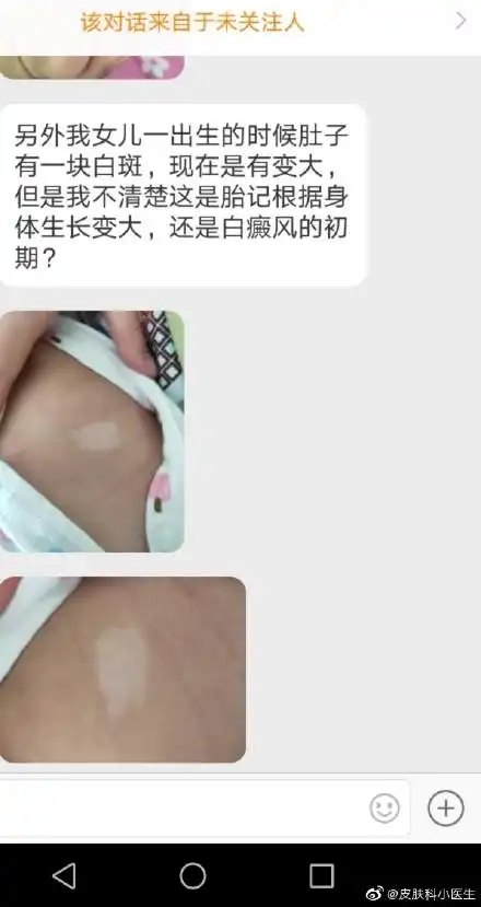 婴儿最常见的湿疹,脂溢性头皮炎,白斑(无色素痣或贫血痣)案例分享