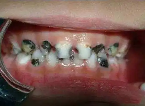 教你如何保护牙齿健康牙龈萎缩牙根外露图片儿童牙龈萎缩牙根外露图片