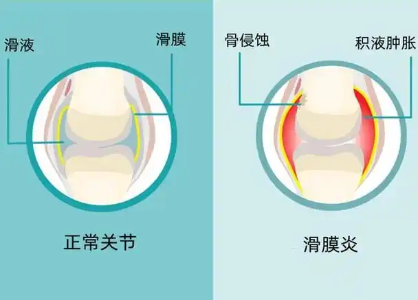 膝盖肿痛,滑囊炎还是滑膜炎,哪个更难治?