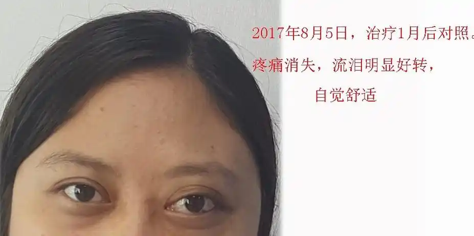 近期甲亢突眼患者治疗对照照片 - 好大夫在线