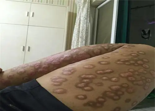 花斑癣腿部特别严重症状图片