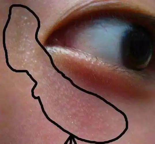 粟丘疹这么做一针见效