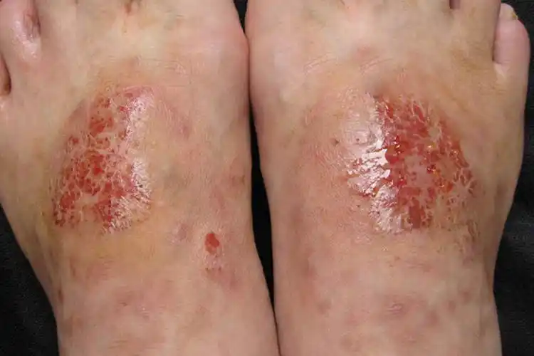 揭秘!湿疹图片初期症状图"高效安全"-第1张图片-浦西博客