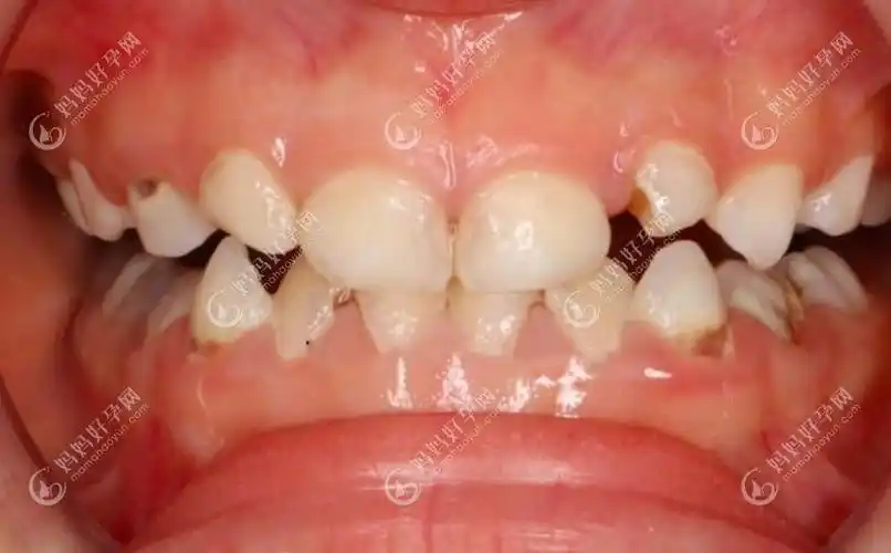 4岁儿童地包天矫正费用及牙套种类分享312岁孩子同样适用