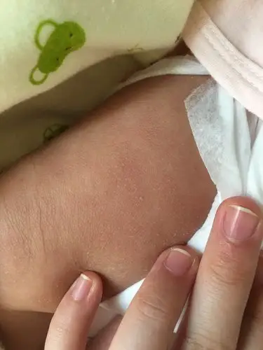 宝宝两个月了身上都是干皮怎么回事?新手妈妈着急
