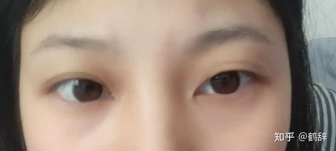 我的眼睛一单一双适合什么样的双眼皮适合开眼角和提肌吗