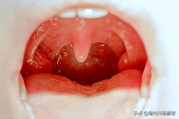 避免引起肾炎发作_咽喉部_控制_情况