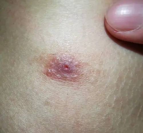 在澳洲的农场被虱子咬了一下 三个月还是好不了?