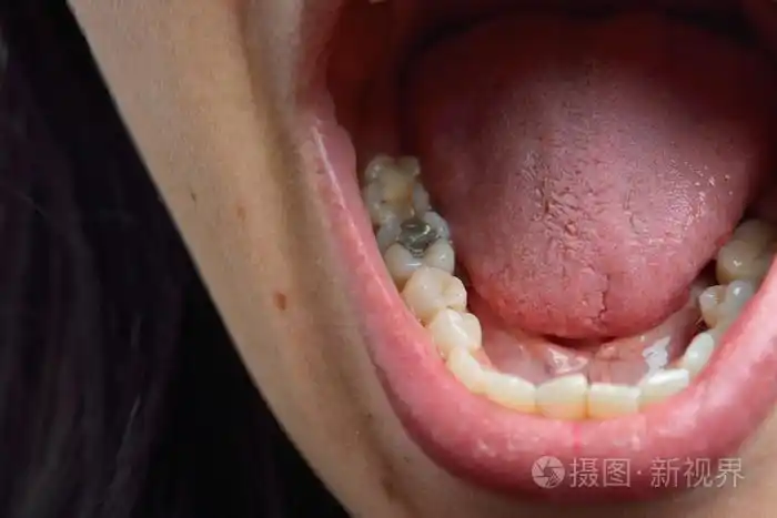 女性患者口中与龋齿的特写.牙科治疗