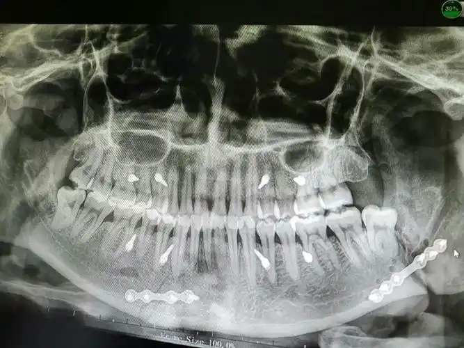 下颌骨骨折术后,我还是那个貌美如花的我吗?