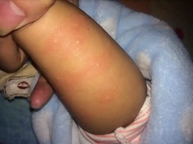 宝宝腿上突然长了好多小米粒一样的