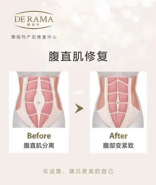 德瑞玛产后修复丨腹直肌分离有什么影响