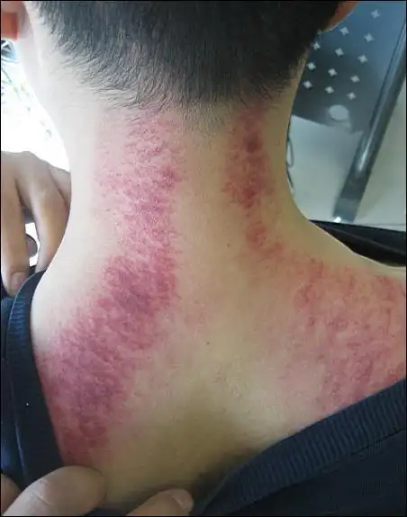 越是出痧黑紫,越是问题严重