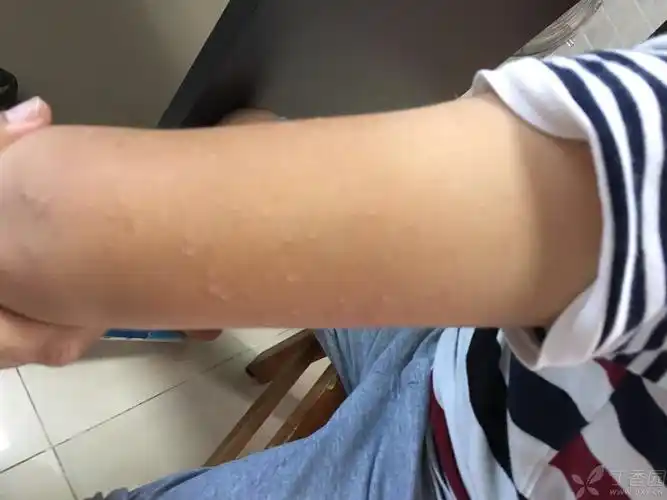 请问这个小孩面部的粟粒状小丘疹是什么病