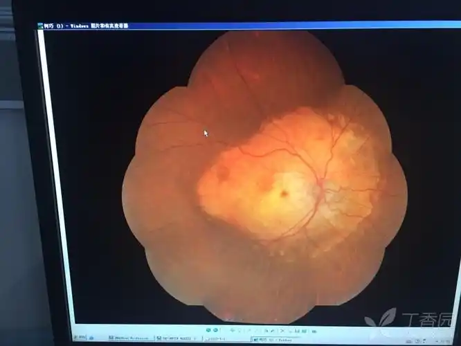 分享一个双眼脉络膜骨瘤的病例 [病例帖]