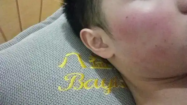 男19 脸部成红色,俗称"高原红",应该是属于遗传,该怎么破?