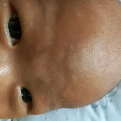 03 推荐回答                     对於这种情况的话是因为汗斑引起的