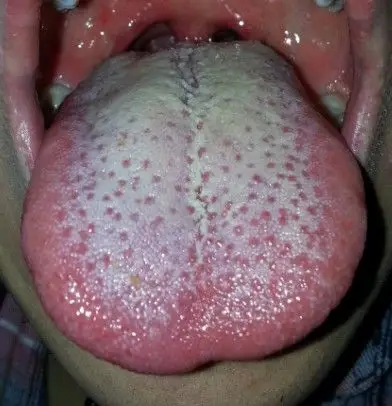 舌苔状态变了,最近脾胃不好吧,请高手解答