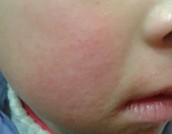 10岁女孩,脸上皮疹