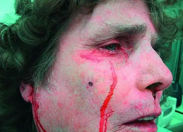 意男子眼睛流血泪 经治疗病情稳定