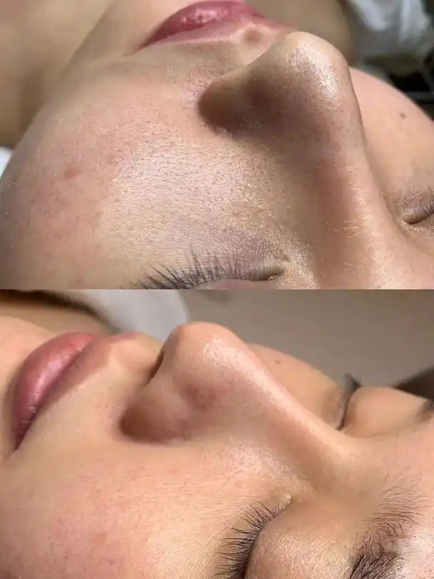 变美项目:超微小气泡