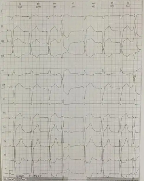 三度房室传导阻滞 起搏器心电图