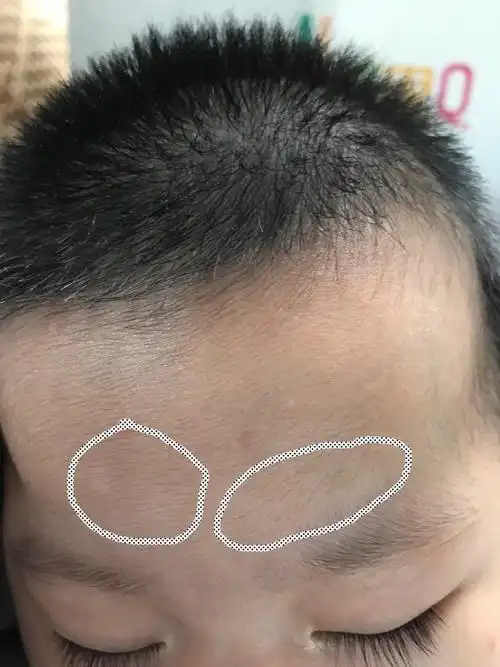 大家知道汗斑吗急