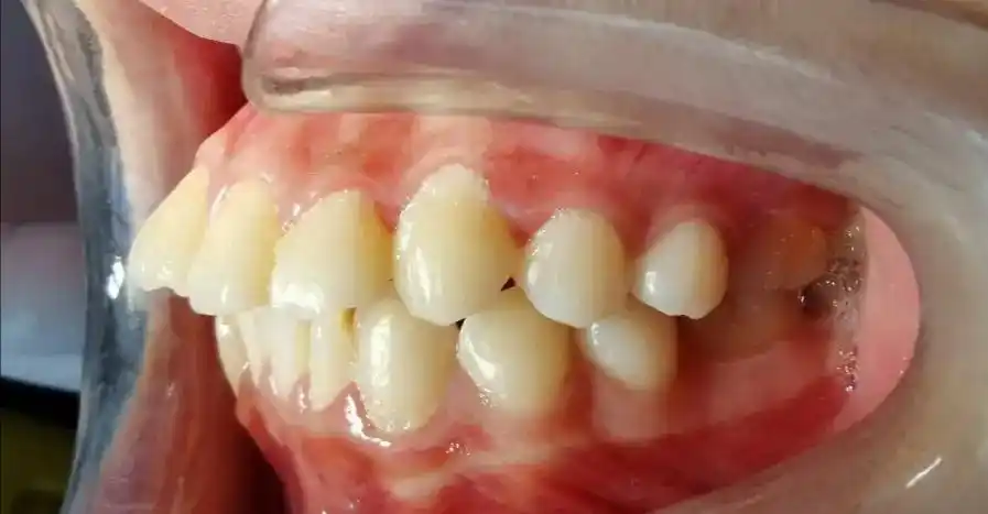 但是牙医眼里的整齐还包括了正常的覆合覆盖,也就是说上前牙得咬住