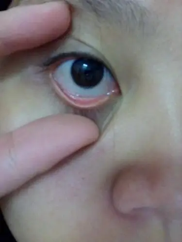 圆球周围的眼白发黄这是怎么了