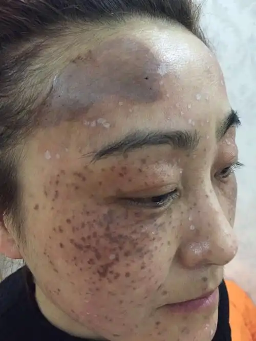 真皮斑怎么掉_百科-8s新商盟